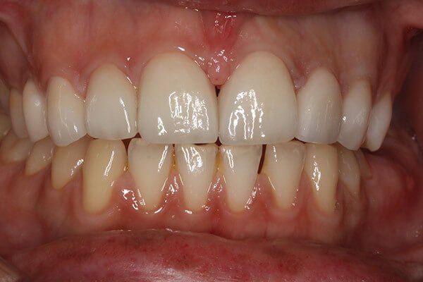 4 veneers placed following tooth whitening