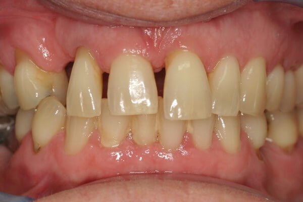 Spacing due to previous tooth loss