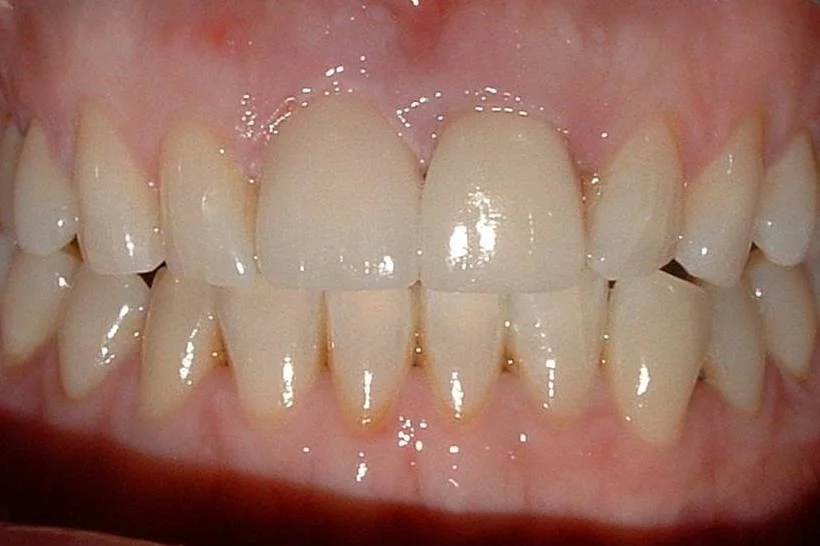 Crowns in Sidcup Cosmetic Dentist Birkbeck Dentistry