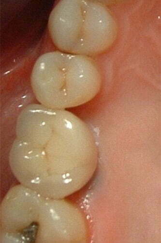 A ceramic crown is fitted to the implant