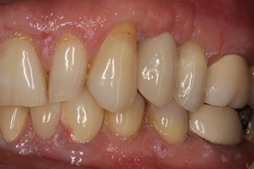 The space is closed with a new ceramic tooth fixed to the implant