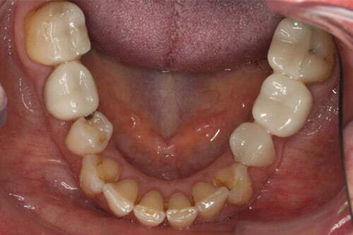 Gaps filled with implants and ceramic crowns