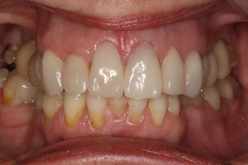 Following extraction, implants Root treatment and veneers  
