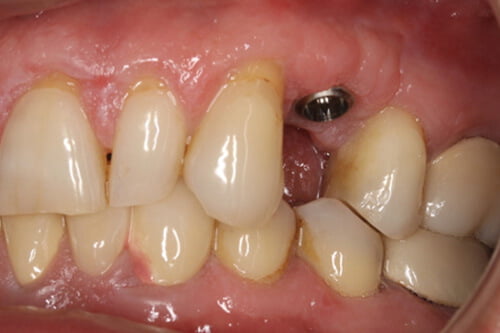 An implant is placed at gum level.