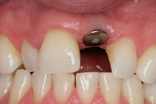 The implant is placed at gum level