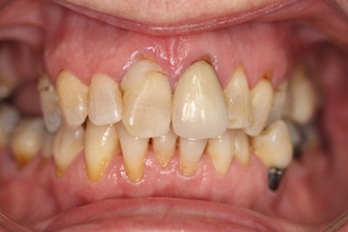 Old discoloured fillings, poor tooth position and stained teeth.