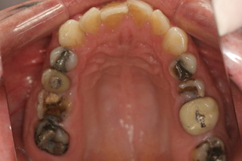 Infected back teeth are breaking up and the old amalgam fillings are breaking