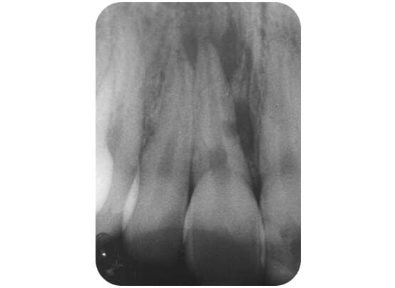 The infection is spreading through the tooth and damaging the supporting bone