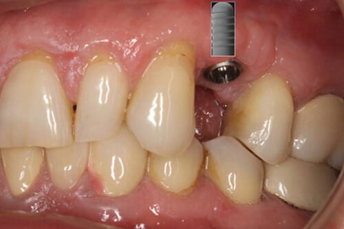 The implant is below the gum.