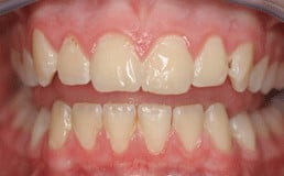 Plaque cannot be seen on the teeth usually