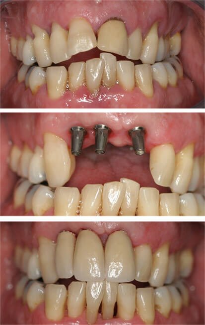 Loose teeth, placed implants, ceramic crowns.