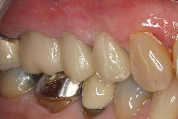 These old crowns were replaced with 3 new ceramic crowns in a single visit