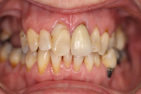 Old silver fillings and discoloured teeth