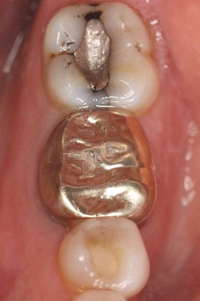 An old gold crown and amalgam filling