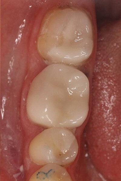 The teeth were cleaned out and restored with bonded ceramic restorations on the same visit.