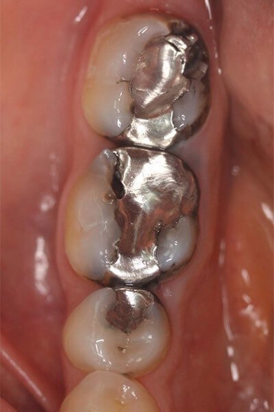 The silver fillings are starting to lose their seal and need replacing