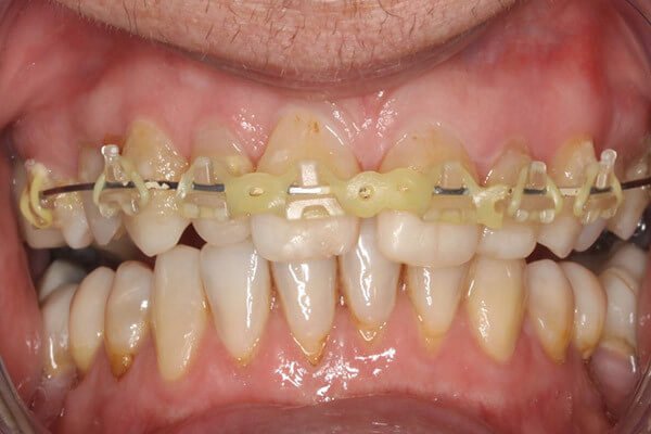 Brace fitted with tooth coloured  brackets
