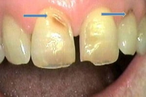 Abfraction wear due to tooth grinding