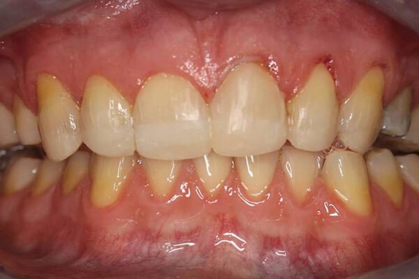 Teeth and bite rebuilt with composite bonding.
