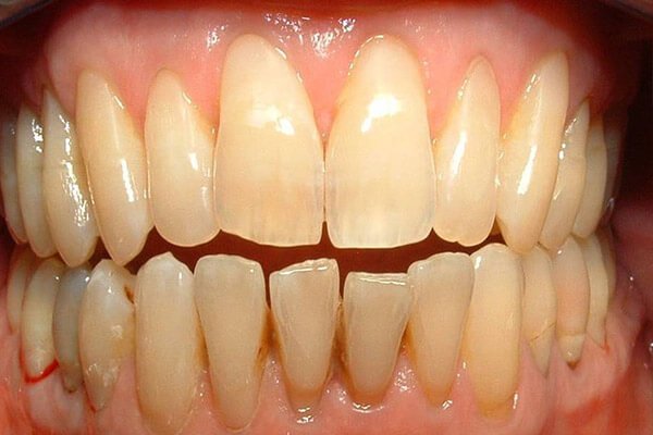 Teeth protected with bonded resin.