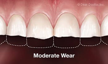 moderate-wear