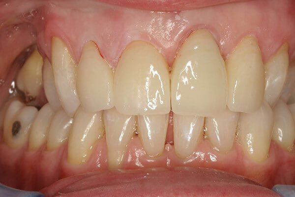 Replaced in a single visit with metal free ceramic crowns