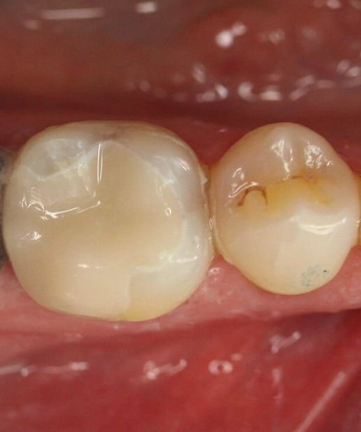 The tooth is restored within one hour with a ceramic restoration
