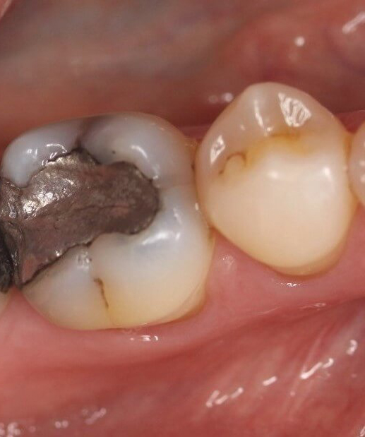 An old amalgam filling is removed
